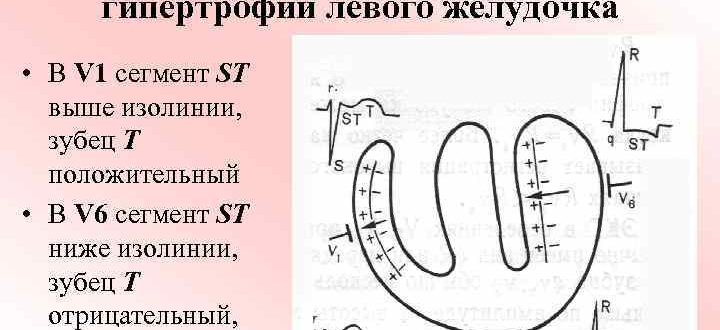 Нарушение процессов реполяризации ЛЖ, ВДСУ