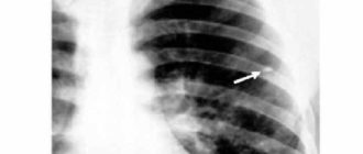 Единичный очаг в легких у ребенка