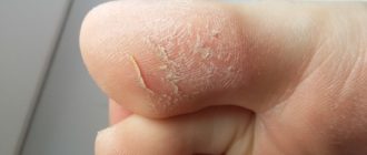 Экзема на большом пальце ноги
