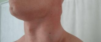 Диффузно фиброзные изменения и увеличенные лимфоузлы