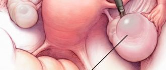 Эндометриоидная киста боли справа и отдают в ногу