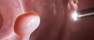 Децидуальный полип и обильные кровотечения при беременности