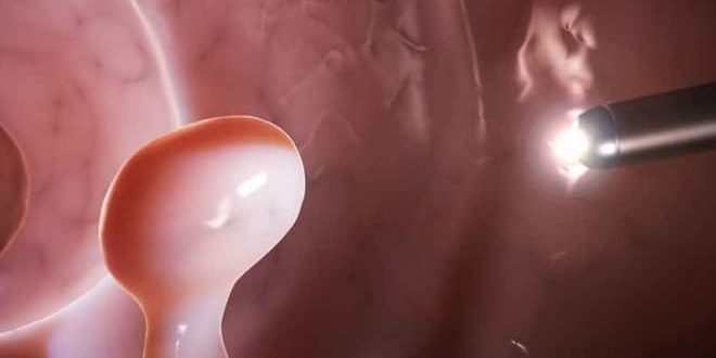 Децидуальный полип и обильные кровотечения при беременности