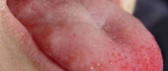 Нарост на языке во время беременности