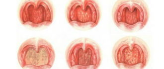 Что-то на задней стенке горла