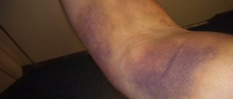 Межмышечная гематома