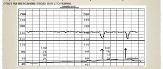 Децелерации на ктг
