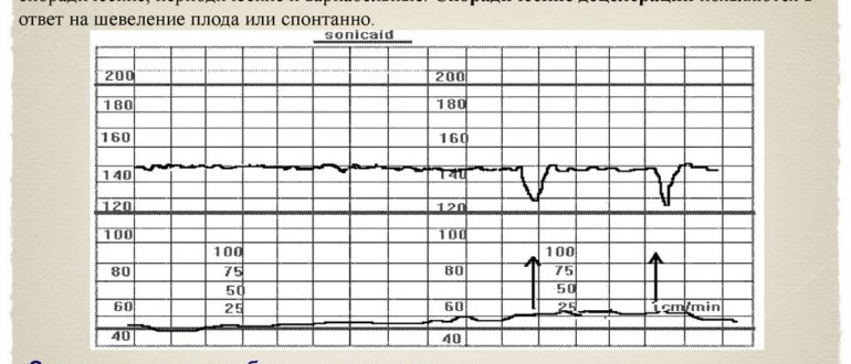 Децелерации на ктг