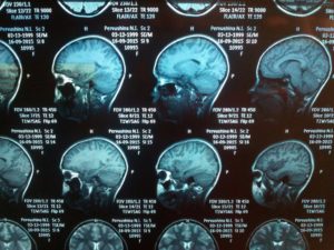 МРТ головного мозга (расшифровка)