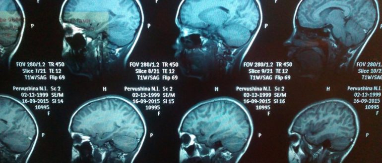 МРТ головного мозга (расшифровка)