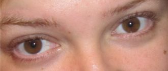 Выпадение бровей и ресниц при жирной коже