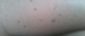 Что за коричневые пятна на предплечье