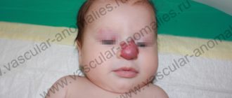 Венозная мальформация у ребенка 3 месяца