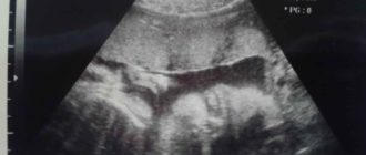 Узи в 30 недель