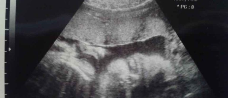 Узи в 30 недель