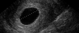 Эндометрий13мм, а плодного яйца нет, и коричневые выделения