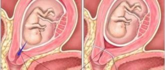 Выделение при ицн