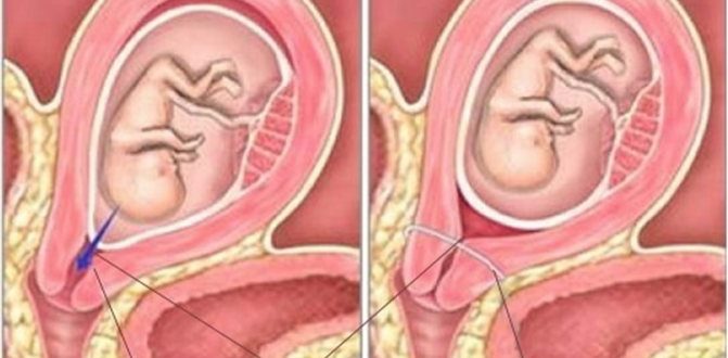 Выделение при ицн