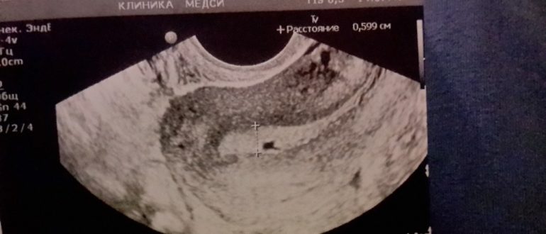 УЗИ непонятный результат