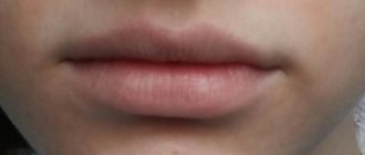 Кожа над верхней губой светлее, чем на остальных участках кожи