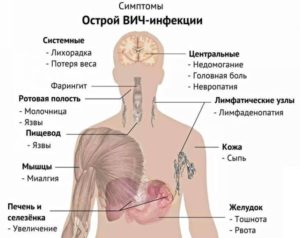 Молочница - признак ВИЧ?