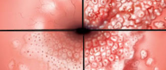 ВПЧ 52 и дисплазия