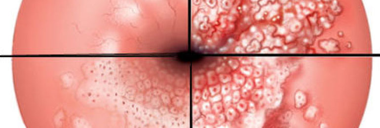 ВПЧ 52 и дисплазия