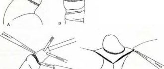 Возможно ли вылечить запущенный вид фимоза без обрезания?
