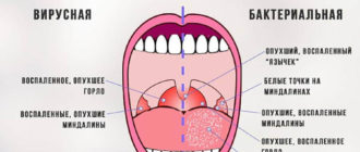 Вирусный или бактериальный тонзиллит