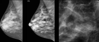 Может ли быть боль в молочной железе после маммографии?