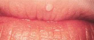 Нарост на губе