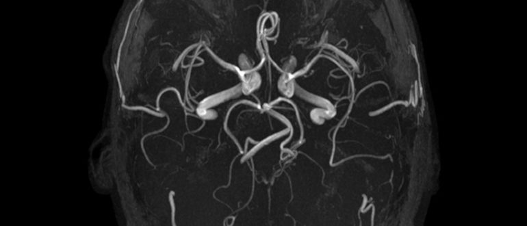МРТ головного мозга (МР сигнал от аденогипофиза изменен)