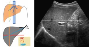 УЗИ ГЕПАТОМЕГАЛИЯ ПРАВАЯ ДОЛЯ 162 ЛЕВАЯ 80