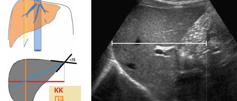 УЗИ ГЕПАТОМЕГАЛИЯ ПРАВАЯ ДОЛЯ 162 ЛЕВАЯ 80