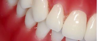 Красная десна