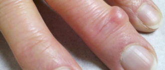На пальцах болючие бугорки