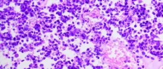 Мелкоклеточный рак легкого