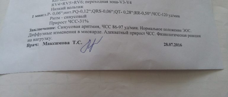 Микроинфаркт, расшифровка заключения по ЭКГ