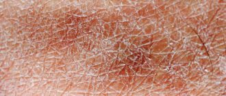 Кожа грубая и сухая