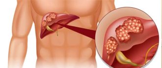 Диарея при раке печени