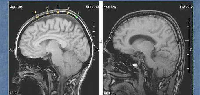 МР картина умеренно выраженной наружной гидроцефалии и точечная боль справа