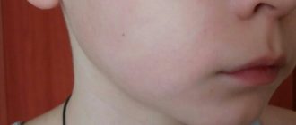 Красная полоса на щеке