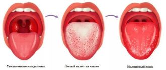На языке постоянно налет и при простуде часто болит горло