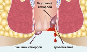 Воспаление геморроя от инфекции в кишечнике? Ципролет и геморрой