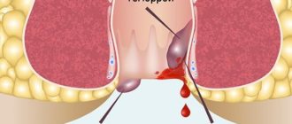 Воспаление геморроя от инфекции в кишечнике? Ципролет и геморрой