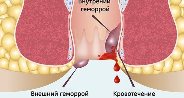 Воспаление геморроя от инфекции в кишечнике? Ципролет и геморрой