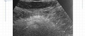 Диффузные изменения поджелудочной железы по типу жировой инфильтрации