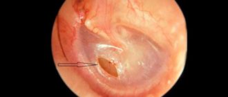 Дырочка в барабанной перепонке