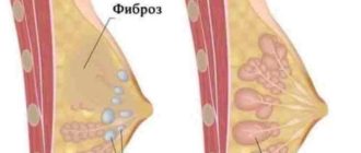 Выделения из одной молочной железы