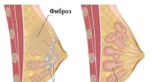 Выделения из одной молочной железы